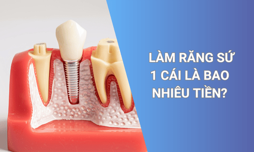 Làm răng sứ 1 cái là bao nhiêu tiền?